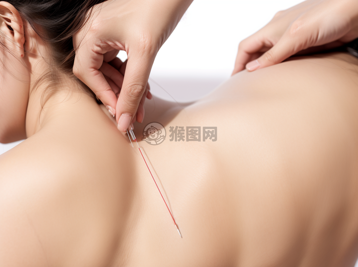 “针灸疗法治疗中的精准插针摄影”